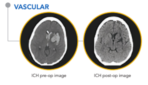 NICONeuroCorp's tweet photo. #StrokeHistory- Numerous studies have been conducted to evaluate surgical outcomes for #ICHstroke patients. Evidence from published data suggests ICH surgical volume reduction impacts functional outcomes. See here: https://t.co/M2Jaj2I2k0 #StrokeAwarenessMonth #neurosurgery #nsgy https://t.co/DuBevrCabi