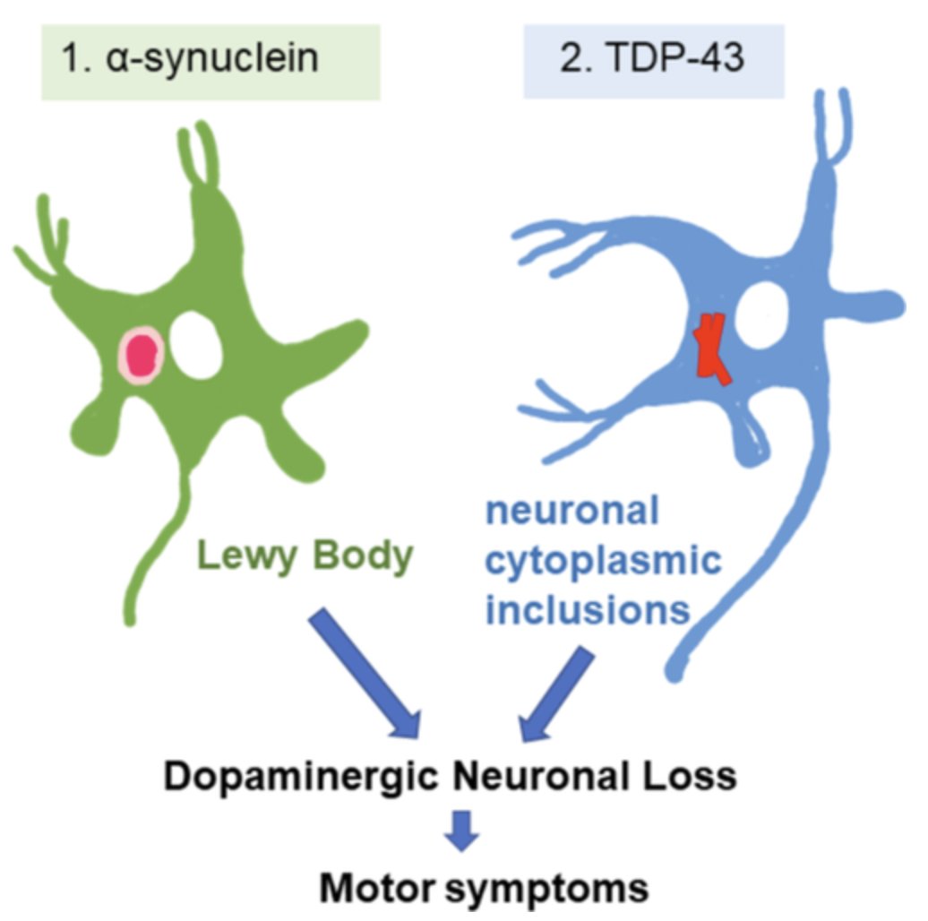TDP-43 can it mimic Parkinson's clinically?
"Accumulation of abnormal TDP-43 protein independently induces dopaminergic neuronal loss in substantia nigra without Lewy pathology; results in typical Parkinson's disease-like motor symptoms." Japanese case: …mentdisorders.onlinelibrary.wiley.com/doi/10.1002/md…