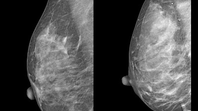 Radiology_AI's tweet photo. #DeepLearning model achieves 89% accuracy in distinguishing  breast density https://t.co/qCxu4BXtRq @cd_salvatore @IussPavia @unimib #mammo #BreastDensity #AI https://t.co/lhKq3DElNM