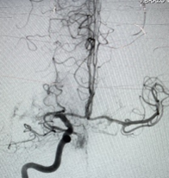 PenNeuro's tweet image. US HCPs: #RED72 case by Dr. Sushant Kale out of West Valley Hospital, AZ. #REDglideDifference #StrokeAwarenessMonth Rx only. For risk info: bit.ly/37YcYIU. Clinical results may vary.