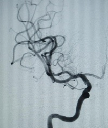 PenNeuro's tweet image. US HCPs: #RED72 case by Dr. Sushant Kale out of West Valley Hospital, AZ. #REDglideDifference #StrokeAwarenessMonth Rx only. For risk info: bit.ly/37YcYIU. Clinical results may vary.