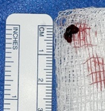 PenNeuro's tweet image. US HCPs: #RED72 case by Dr. Sushant Kale out of West Valley Hospital, AZ. #REDglideDifference #StrokeAwarenessMonth Rx only. For risk info: bit.ly/37YcYIU. Clinical results may vary.