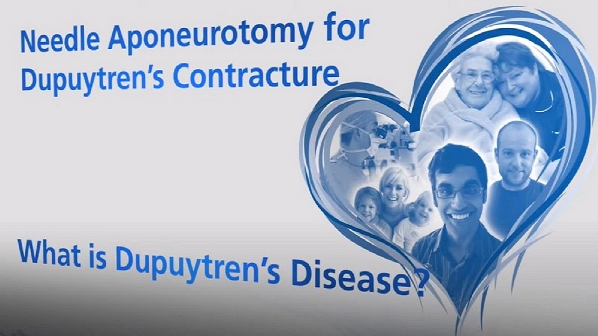 ipokrate's tweet photo. Needle Aponeurotomy - Patient Information...
Watch and learn today from the Pulvertaft Videos series on "Needle Aponeurotomy for Dupuytrens Disease from the Pulvertaft Hand Centre in Derby."
https://t.co/sT1pKqCob1
#ipokrate #conference #doctor https://t.co/Of7IwymyZR