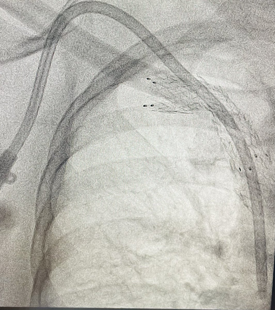 Where there's a will there's a way .Placing a permcath via a blocked SCV stent ( which wasnt placed by me)😀
#vascular #svsvascular #renalfailure #dialysis