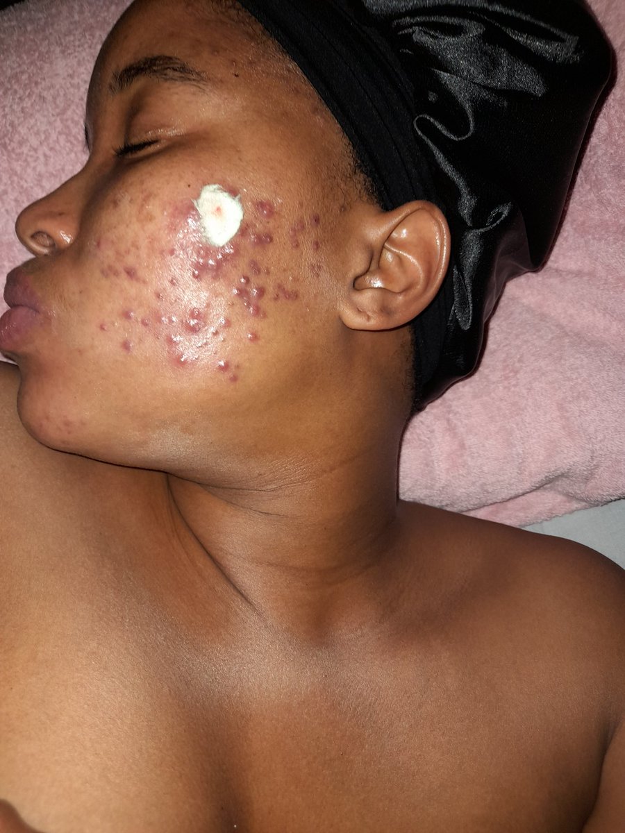 Amo_Mogale's tweet photo. Today marks 6months since I started my yourney with #acnetane it's been long & difficult having to deal with dry skin,iching,the exhausting,the mood swings ๐ญ bt I'm almost done #skinjourney .Now I need chemical peel to clear dackspot & my dry pain lips. https://t.co/b57qSBzHga