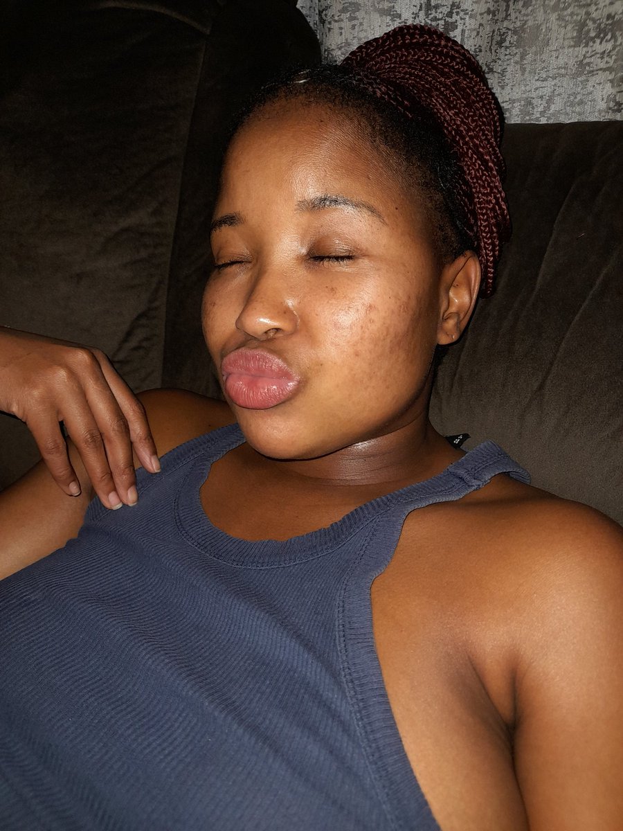 Amo_Mogale's tweet photo. Today marks 6months since I started my yourney with #acnetane it's been long & difficult having to deal with dry skin,iching,the exhausting,the mood swings ๐ญ bt I'm almost done #skinjourney .Now I need chemical peel to clear dackspot & my dry pain lips. https://t.co/b57qSBzHga