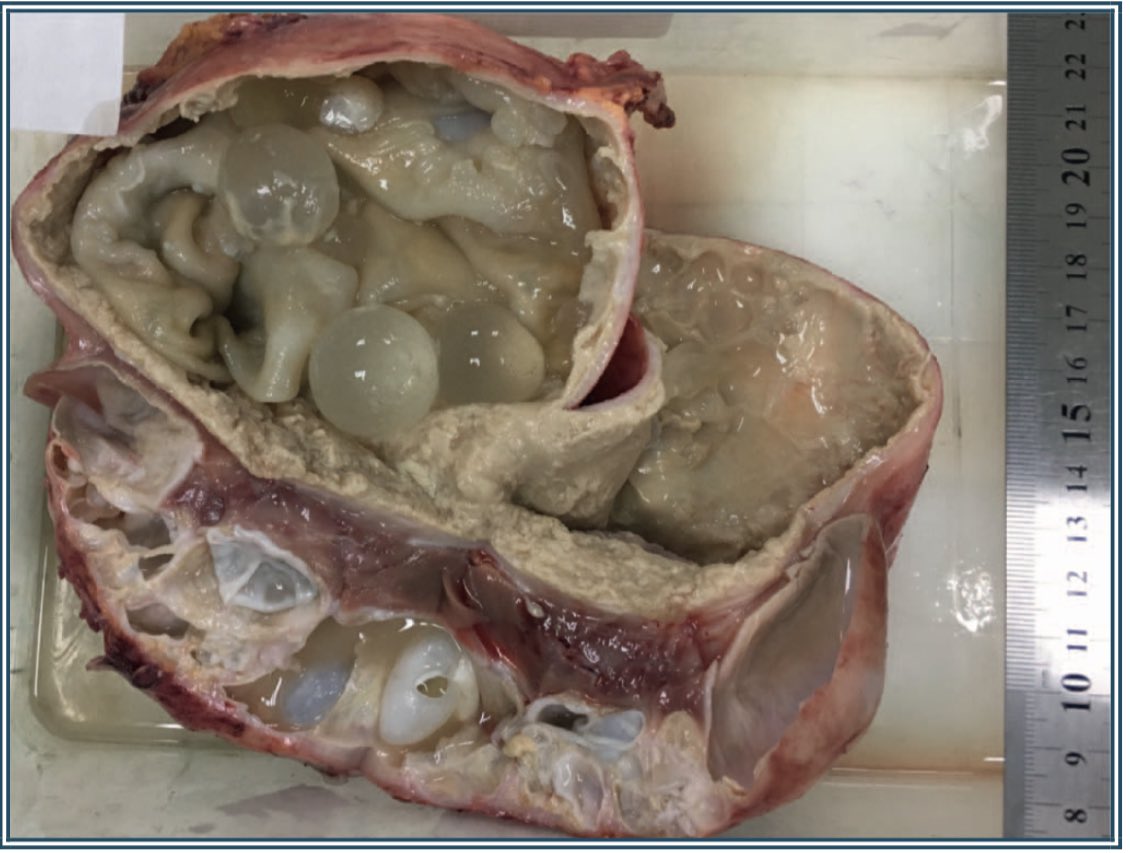 Eylül Gün, MD FRCPath tweet media