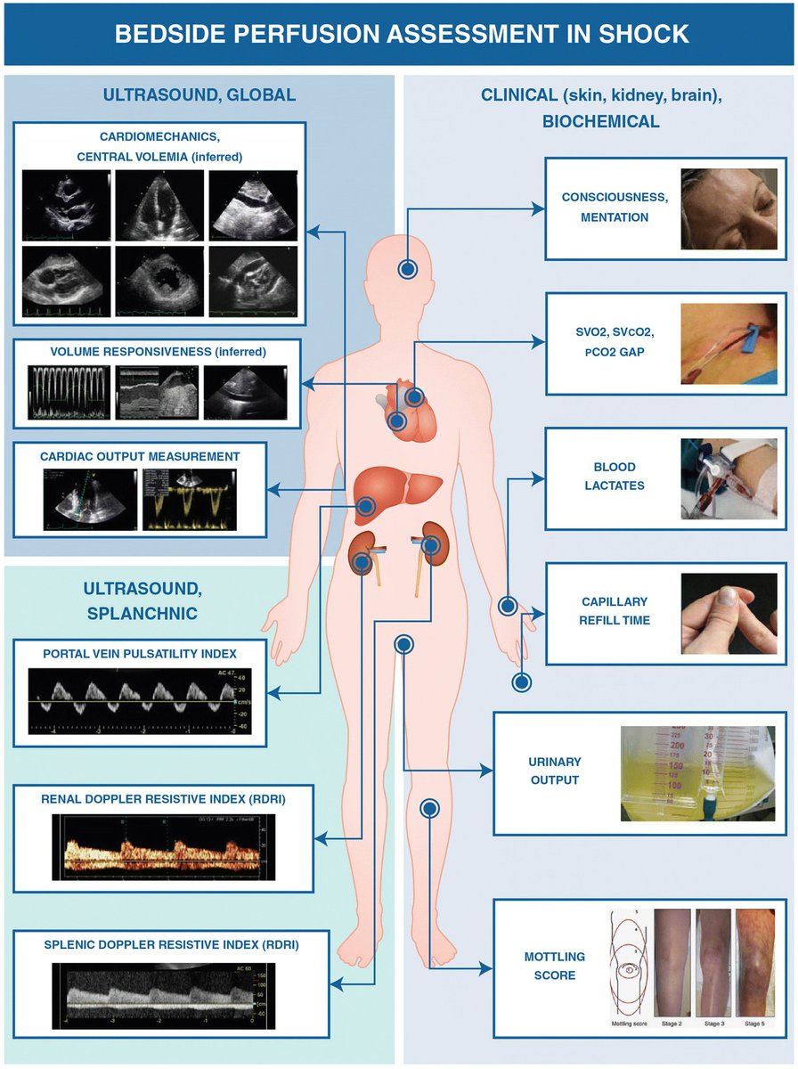 NephroP's tweet photo. Nice diagram depicting assessment of organ perfusion in a patient with #shock using #POCUS + conventional parameters.
#MedEd #VExUS #CriticalCare 
From 🔗https://t.co/2YAG7ISUsK https://t.co/Qax6ny7x9K