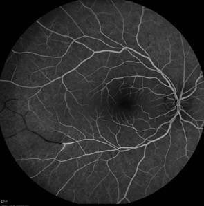 The Case of the Dizzy and Confused:

A 32 year old has had 4 weeks of progressive confusion and vertigo. Exam shows a mild left hemiparesis and end-gaze nystagmus with right upward gaze. 

What’s going on here #neurotwitter?