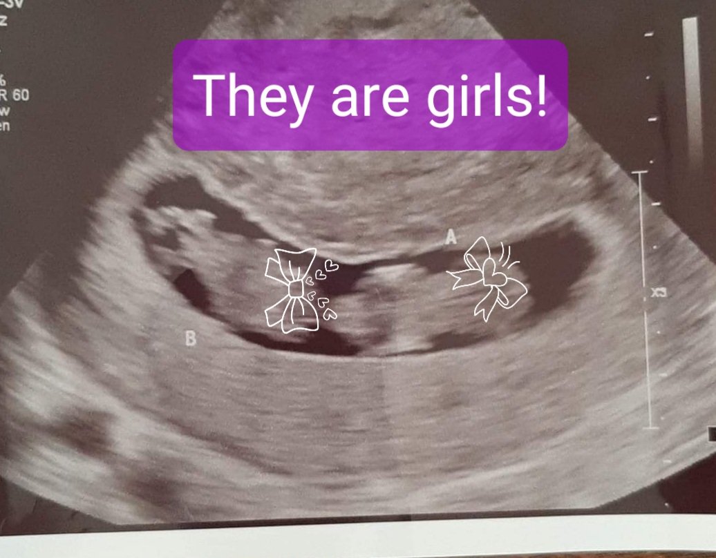 Celestia_SP's tweet photo. Recently found out I'm pregnant with identical twins girls. Of course we are *those* kinds of parents and our names for them are Valkyrie and Ce'Nedra. Badass names for badass babies. #skulduggerypleasant #belgariad @DerekLandy Thanks for having characters with cool names! https://t.co/g1wVVncxL6