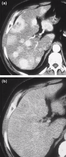 marklewismd's tweet photo. Check out the images below
They aren't slices through 2 different livers
They're the SAME patient, on the SAME day, just with variations in IV contrast delivery
The shortage of CT contrast renders many solid tumor oncologists 'visually impaired' &amp; less able to help our patients! https://t.co/u5AeAPVBLm