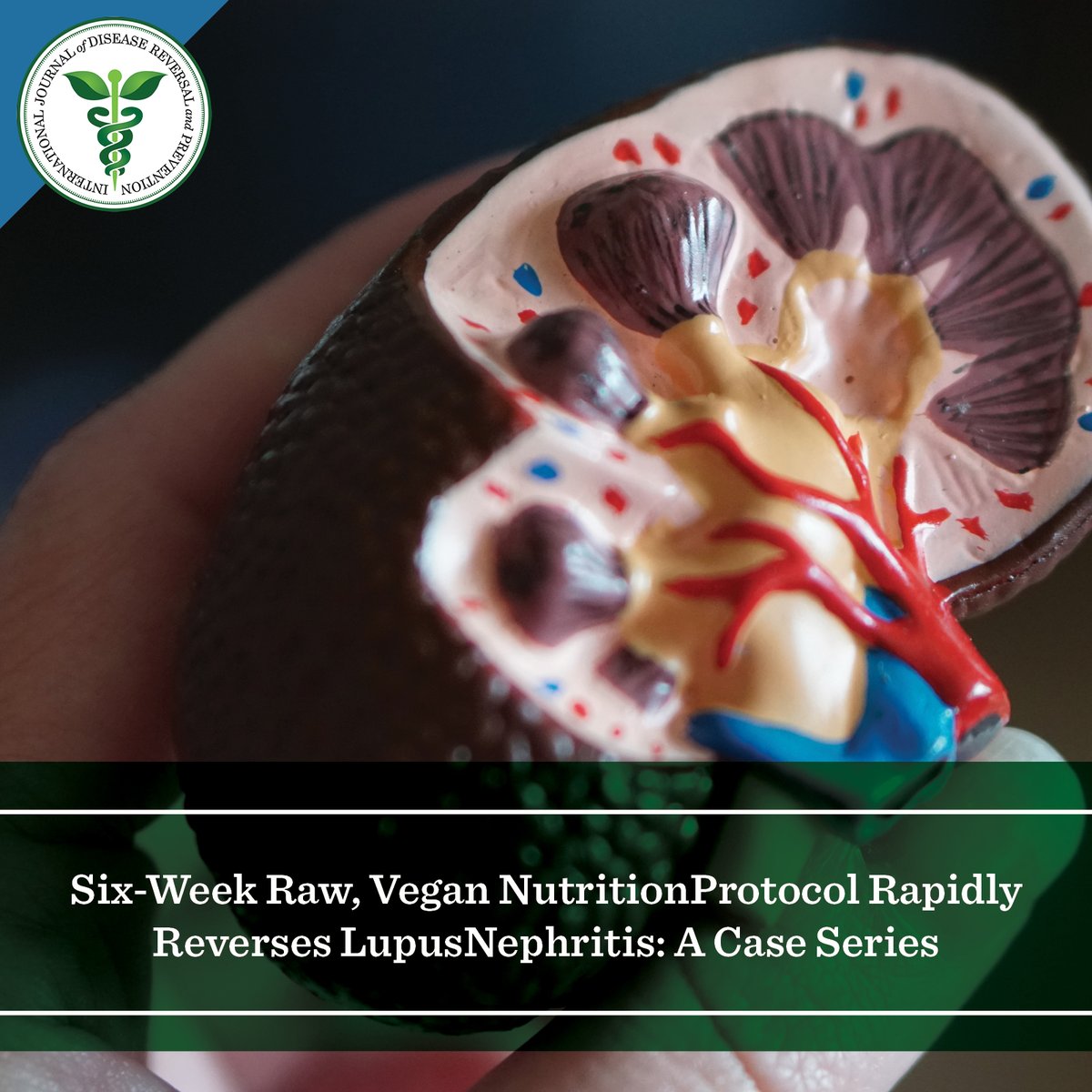ijdrp's tweet photo. This case study by @goodbyelupus in IJDRP Vol 1, No 1, details two patients with SLE-related nephritis. The condition of both patients dramatically improved after they adopted a WFPB diet!

Read more at https://t.co/z3XF94Ax2M. https://t.co/yiDuOpiKF4