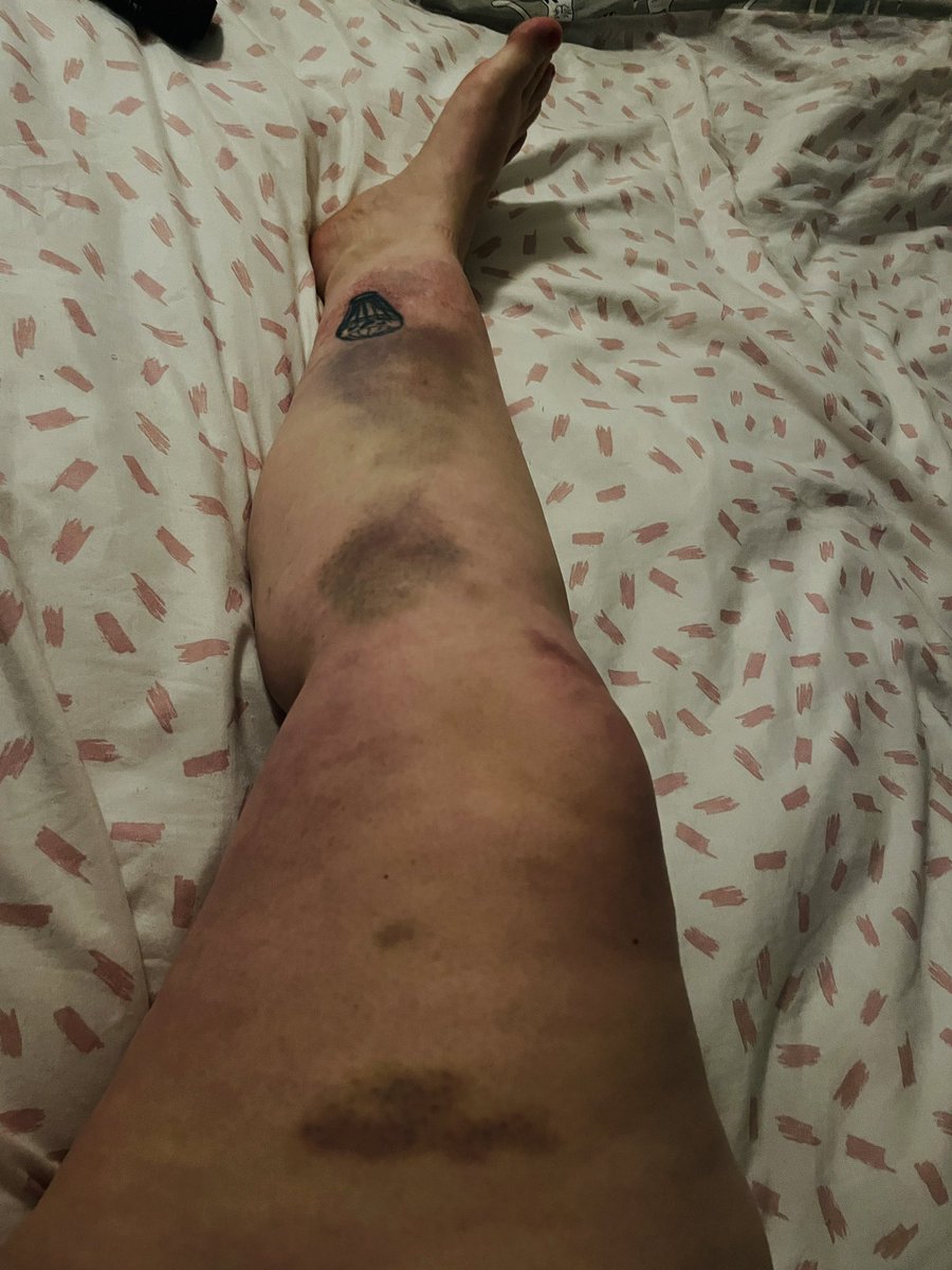 abiwardbristol's tweet image. Bruising update #brupdate