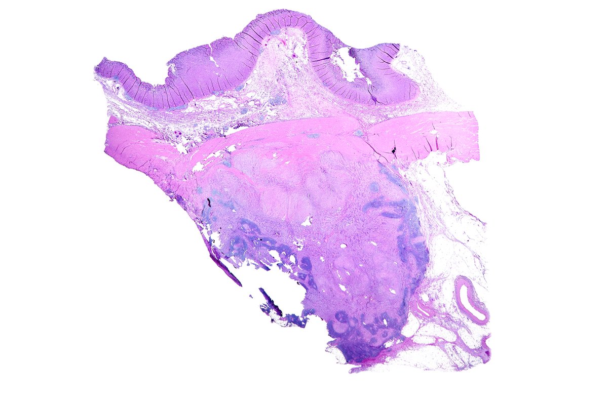 Nothing to see here but a gastric schwannoma plopped in the muscularis propria with a lovely lymphoid cuff.