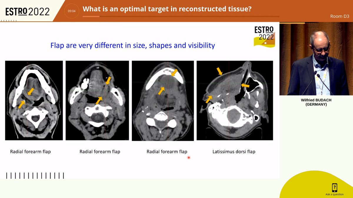 AiroHead_Neck's tweet photo. Back from #ESTRO2022. Dr. Budach about CTV in PORT with flap. Lack of data: patterns of recurrence, depth of infiltration and interval between Sx and PORT, flap types and probability of cancer infiltration. 3-6 mm of the flap should be included if Rclose https://t.co/Eztrgdlz3d