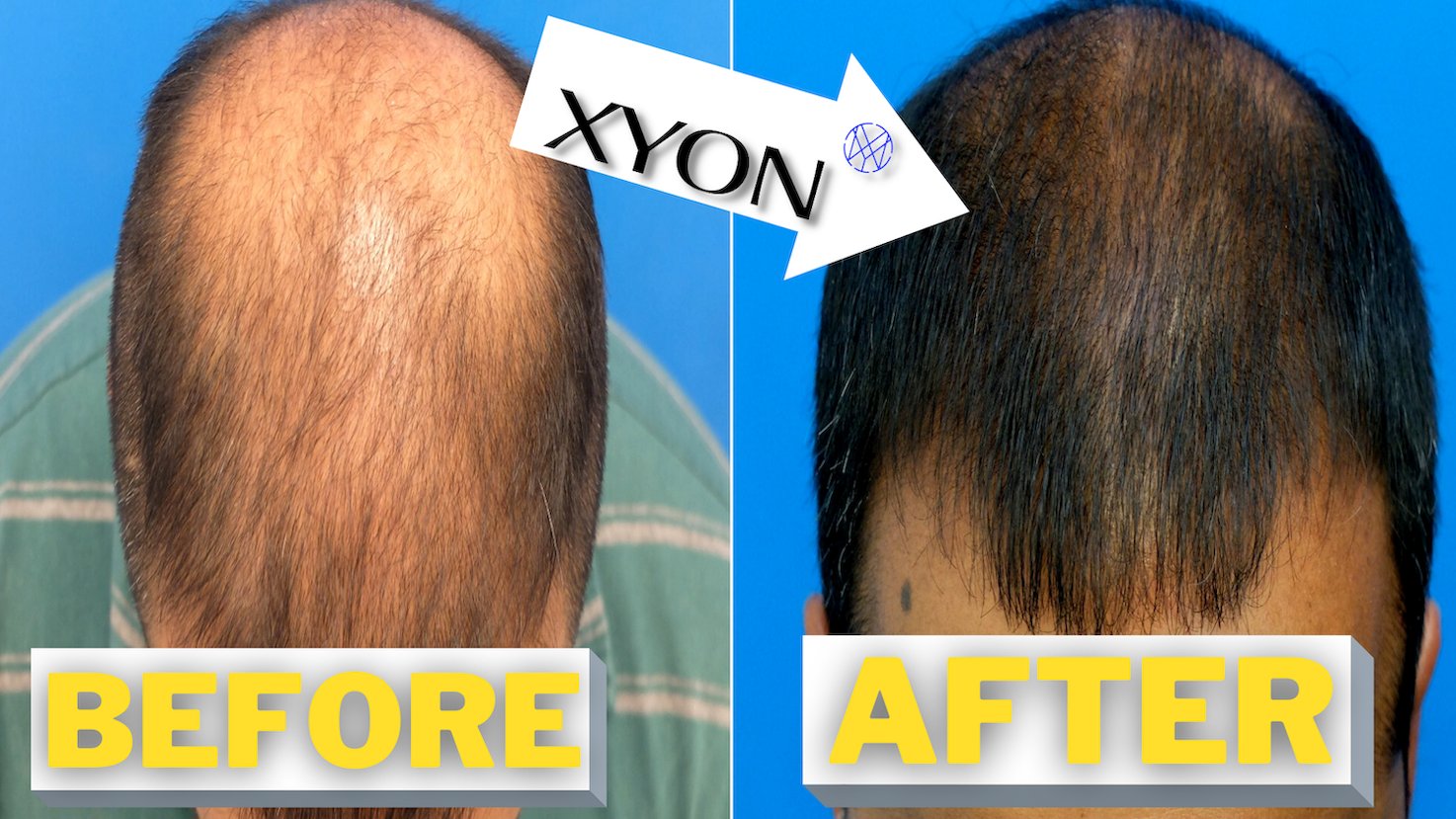 Hair Transplant Network on Twitter: Hair Transplant Network on Twitter: