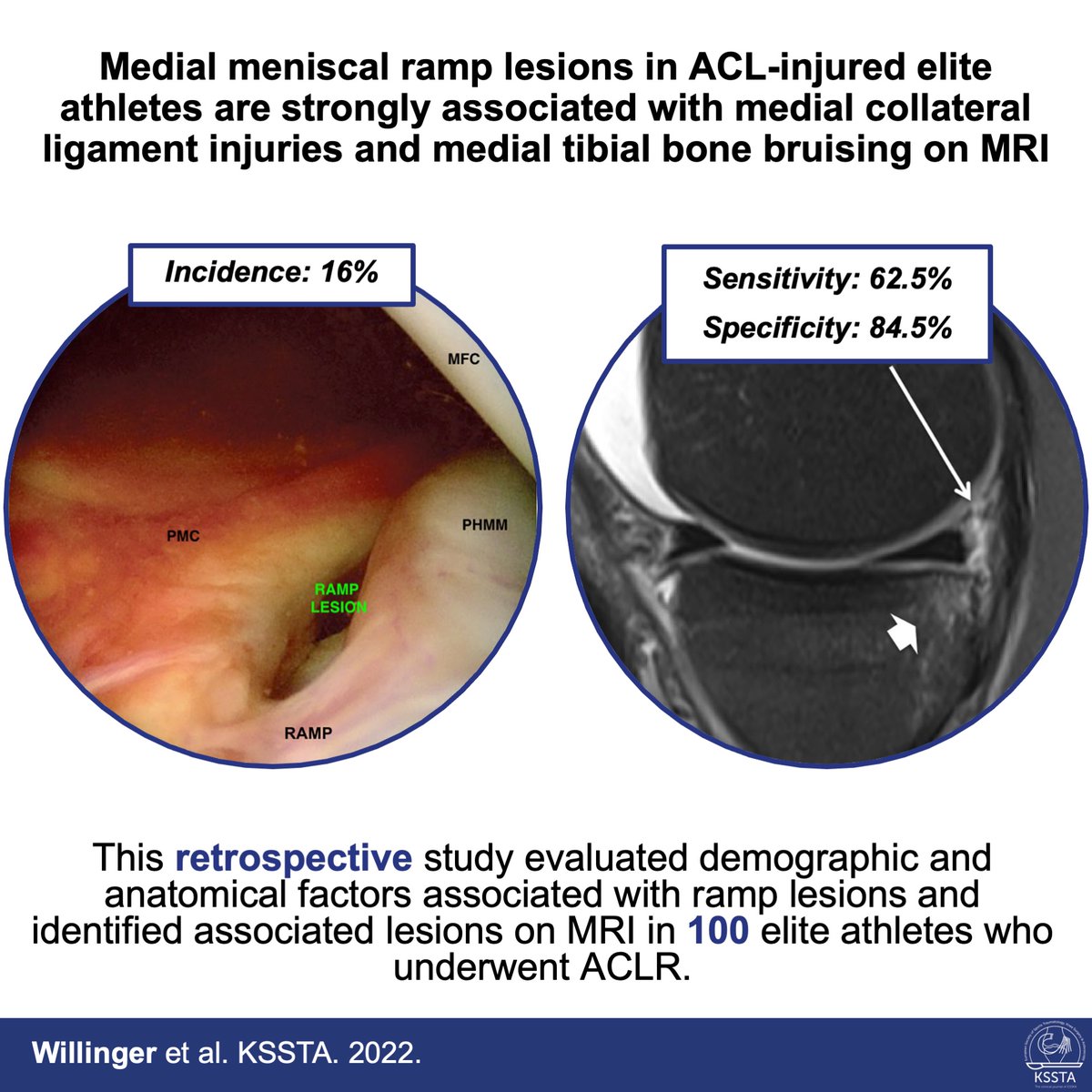 doi.org/10.1007/s00167…

This study identifies associations of meniscal ramp lesions with concomitant injuries. Ramp lesions are associated with medial collateral ligament injuries and tibial plateau bone bruises.

#sportstraumatology #ACL #knee #meniscus #ramplesion