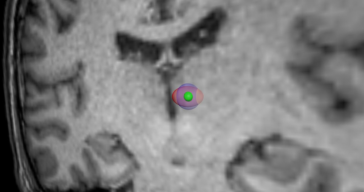 Radiosurgery.
This is our most recent work in cancer refractory, mixed pain. The red is #Cyberknife the green Gamma. Triple target irradiation, we might be closer to radiomodulation than you think😉. Dr E. Alho #Radiosurgery #pain #caner #PalliativeCare #neuroscience <a href="/ISRSy/">ISRSy</a>