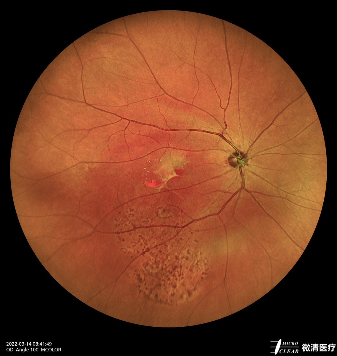 Microcleartec's tweet photo. #AMD (Age-related Macular Degeneration)
Pictured by Apollo, the #ConfocalRetinalOphthalmoscope
#retinopathy #autofluorescence #fluorescenceangiography #funduscamera #retinaldiseases #Oct #laserscanning https://t.co/wC2tskw1jR