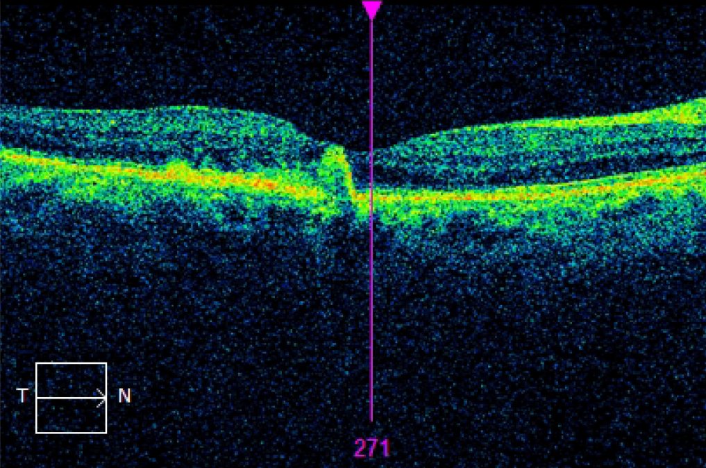 #AMD (Age-related Macular Degeneration)
Pictured by Apollo, the #ConfocalRetinalOphthalmoscope
#retinopathy #autofluorescence #fluorescenceangiography #funduscamera #retinaldiseases #Oct #laserscanning