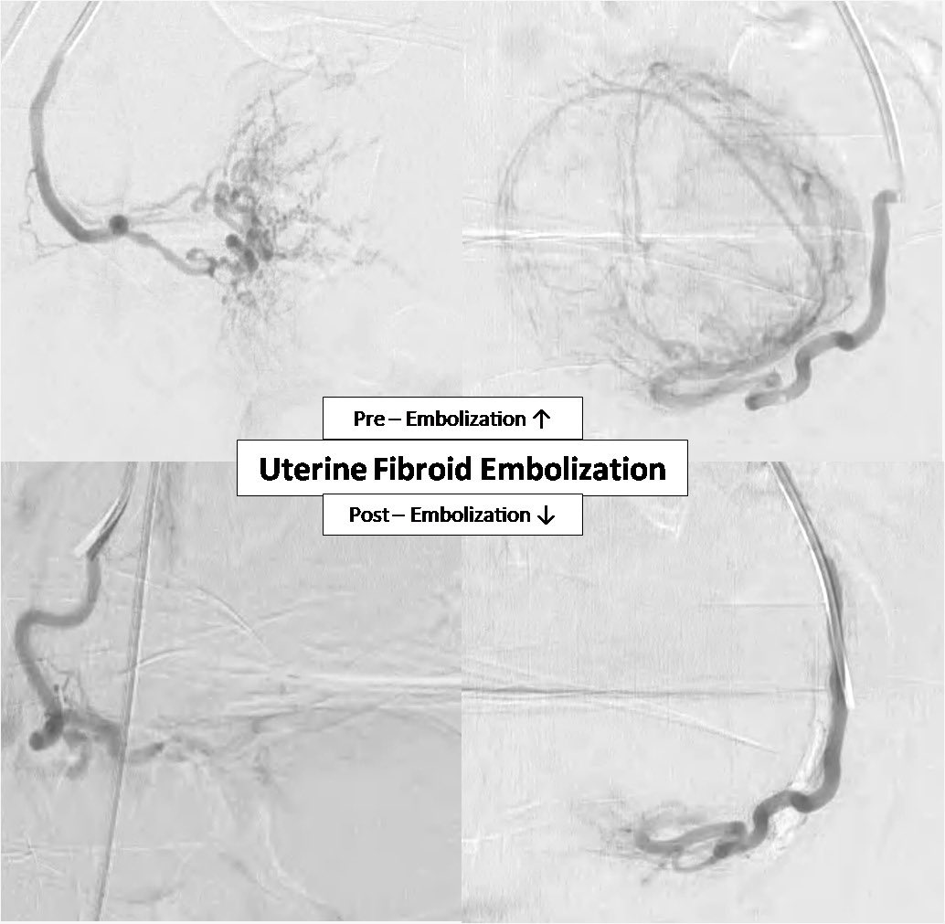 imnagateja's tweet photo. Uterine fibroids safely treated with Uterine fibroid embolization (UFE) without surgery. No blood loss, No long hospital stays, Quick recovery. #ask4UFE #Fibroids #AvoidSurgery #irad #InterventionalRadiology https://t.co/dXKew6VvQo