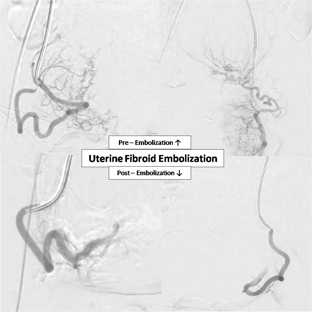 imnagateja's tweet photo. Uterine fibroids safely treated with Uterine fibroid embolization (UFE) without surgery. No blood loss, No long hospital stays, Quick recovery. #ask4UFE #Fibroids #AvoidSurgery #irad #InterventionalRadiology https://t.co/dXKew6VvQo