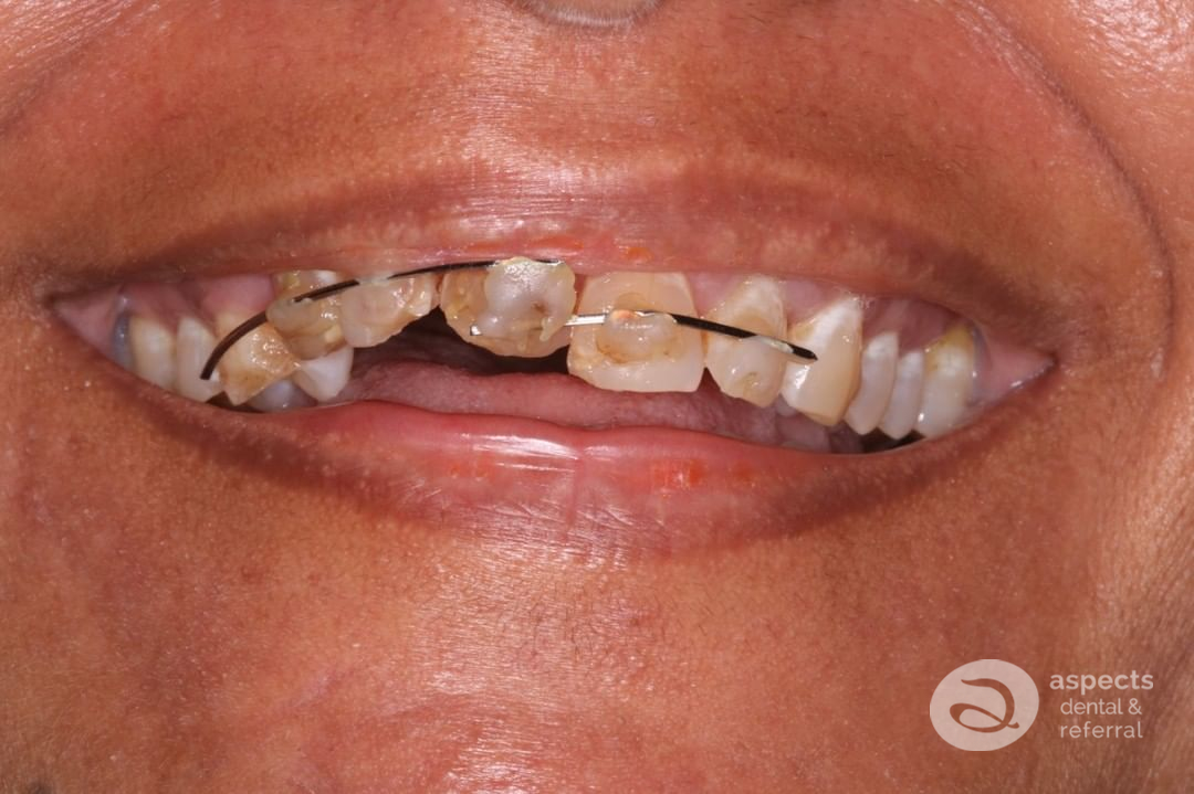 Aspectsdental's tweet image. What a journey! This lovely lady was unfortunate to have trauma to her #FrontTeeth when she came to see Aspects Dental in #MiltonKeynes. We were able to restore her confidence and smile using #DentalImplants - aspectsdental.com/dental-implant… - Call Aspects Dental on 01908 506199.