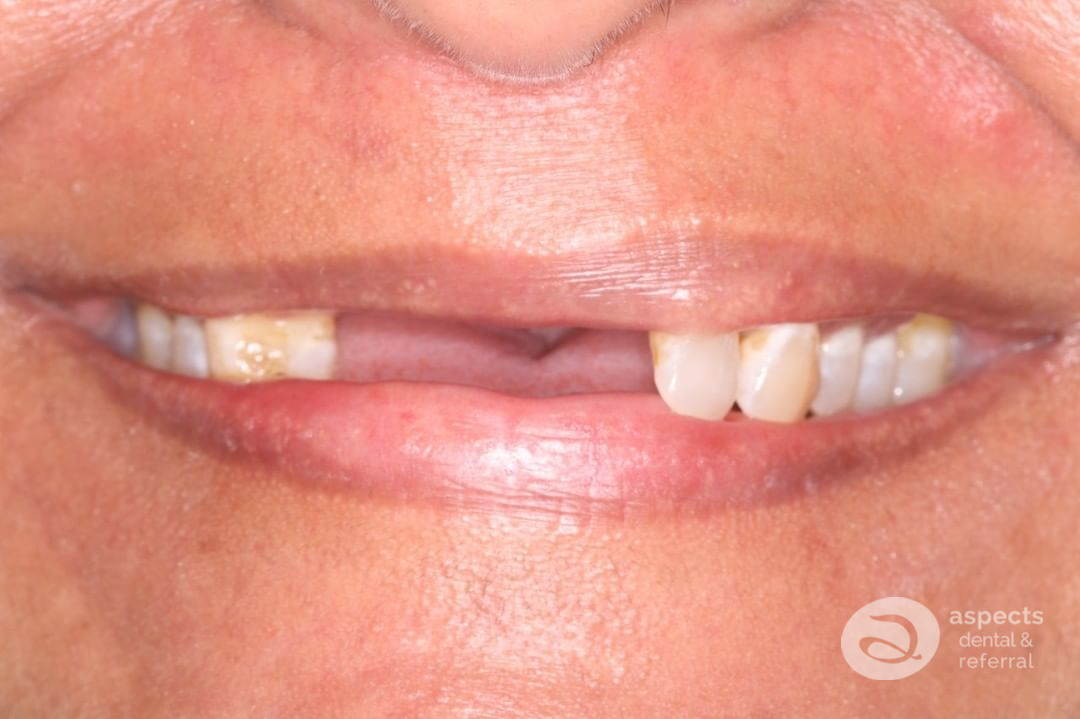 Aspectsdental's tweet image. What a journey! This lovely lady was unfortunate to have trauma to her #FrontTeeth when she came to see Aspects Dental in #MiltonKeynes. We were able to restore her confidence and smile using #DentalImplants - aspectsdental.com/dental-implant… - Call Aspects Dental on 01908 506199.