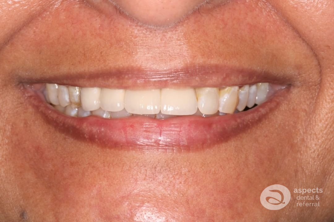 Aspectsdental's tweet image. What a journey! This lovely lady was unfortunate to have trauma to her #FrontTeeth when she came to see Aspects Dental in #MiltonKeynes. We were able to restore her confidence and smile using #DentalImplants - aspectsdental.com/dental-implant… - Call Aspects Dental on 01908 506199.