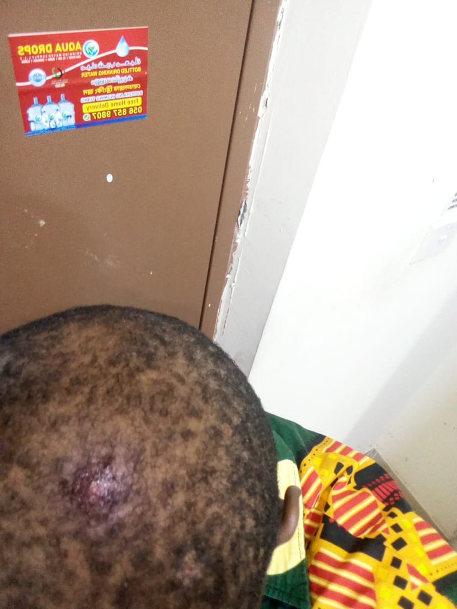 These are the wounds after suffering from mobile Radiation am now fighting to avoid Brain cancer.