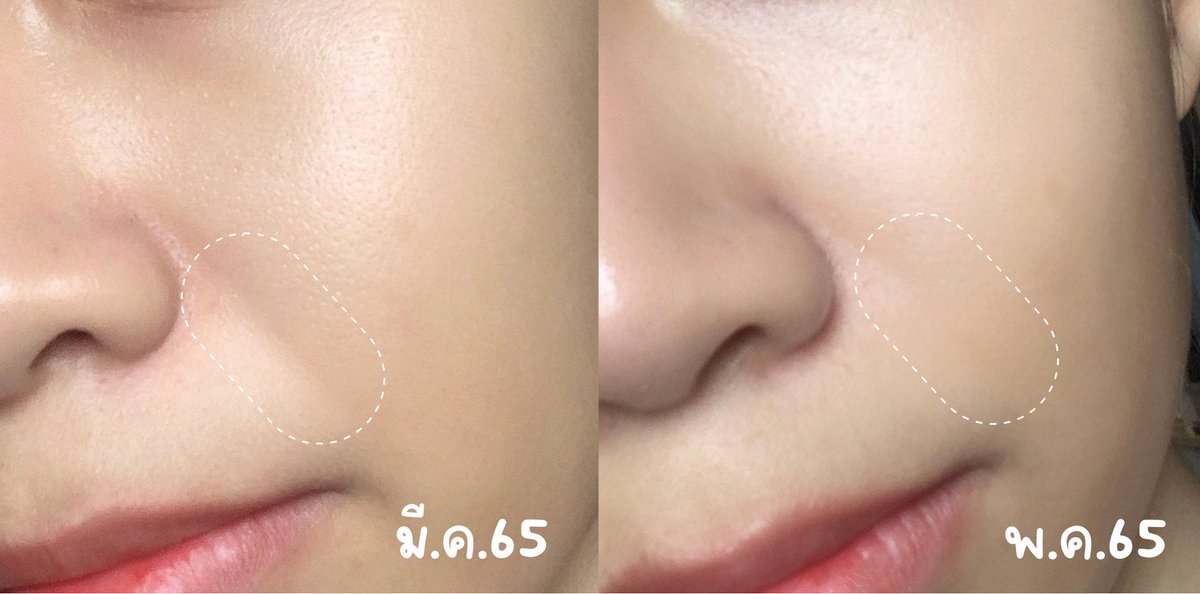 BamPickIt's tweet photo. เราคนเดียวรึเปล่าที่ชอบลองครีมซอง ตัวนี้เราเห็นคนรีวิวแบบขวดเลยไปหาซองมาลองส่วนตัวมีปัญหาเรื่องร่องแก้ม เราลองแล้วรู้สึกว่ามันโอเคขึ้น แต่ใดๆคือส่วนผสมนางปังมากนะ ได้ทั้งไฮยา คอลลาเจน และวิตามินซีด้วย ถ้าเทียบกับราคาแล้ว 45.- เอง #Howtoperfect #รีวิวเซเว่น https://t.co/Ij77WJBjGO