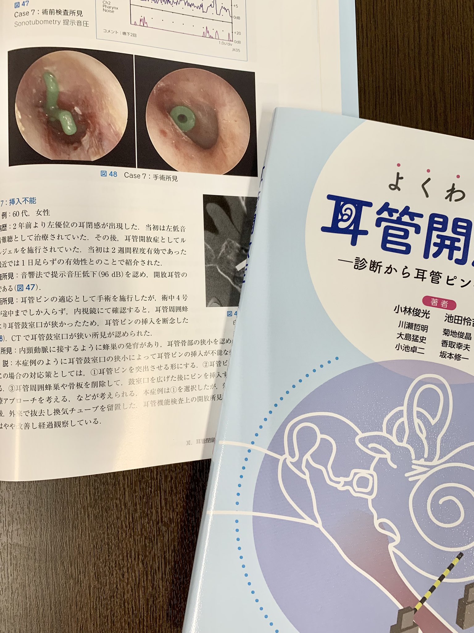 よくわかる耳管開放症 : 診断から耳管ピン手術まで よくわかる耳管開放症 診断から耳管ピン手術まで 小林俊光
