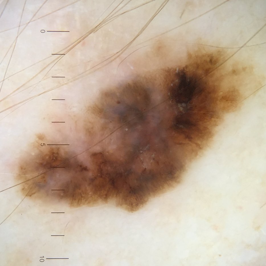 docwilde69's tweet photo. Da hab ich wieder was für ein neues #DermatoskopieQuiz gefunden: männlicher Pat., 49J, Routine Hautkrebsscreening. https://t.co/S2y1coy3to