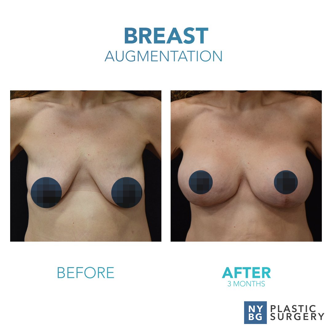 DrKevinSmall's tweet photo. Increase breast volume and improve definition for a fuller, more youthful bust - like Ida did!
 
For more patient success, visit: https://t.co/FrUaF37RVL
#NYBGPlasticSurgery #PlasticSurgeryAfterWeightLoss #LowerBodyLift #Inspiration #Motivation #Success https://t.co/l1vePcG3HW