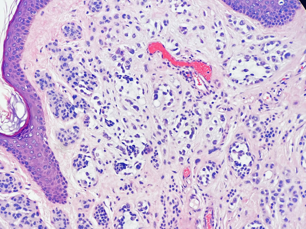 DiegoMoralesN's tweet photo. Intradermal nevus with interstitial mucin deposition.
Suggested read PMID: 18496424
#pathtwitter #dermpath #tooprettynottoshare #FreudeAnDerMorphologie #pathology #reallifedermpath #dermtwitter https://t.co/fyp5t1nOGA