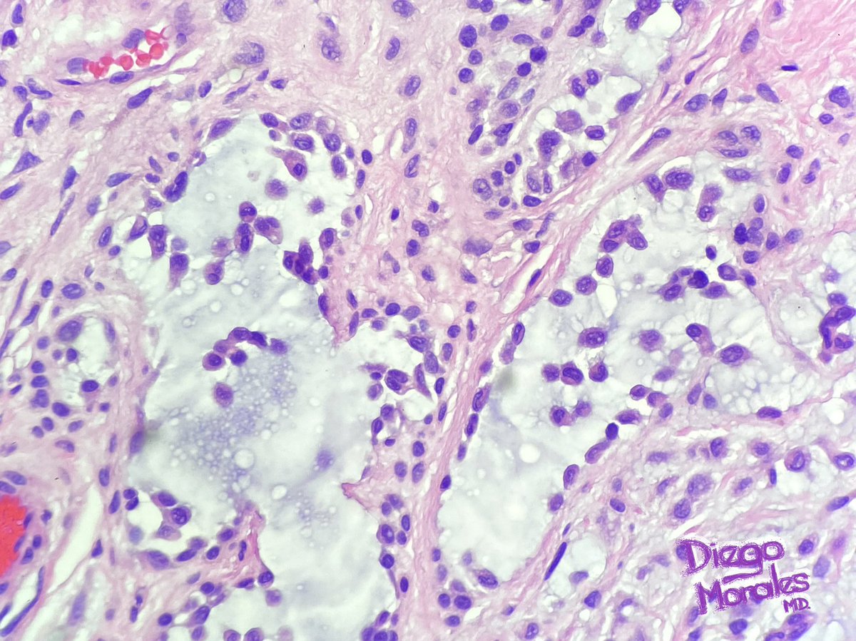 DiegoMoralesN's tweet photo. Intradermal nevus with interstitial mucin deposition.
Suggested read PMID: 18496424
#pathtwitter #dermpath #tooprettynottoshare #FreudeAnDerMorphologie #pathology #reallifedermpath #dermtwitter https://t.co/fyp5t1nOGA