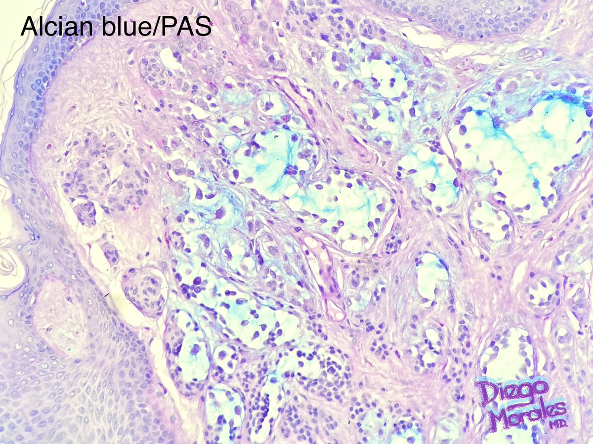 DiegoMoralesN's tweet photo. Intradermal nevus with interstitial mucin deposition.
Suggested read PMID: 18496424
#pathtwitter #dermpath #tooprettynottoshare #FreudeAnDerMorphologie #pathology #reallifedermpath #dermtwitter https://t.co/fyp5t1nOGA