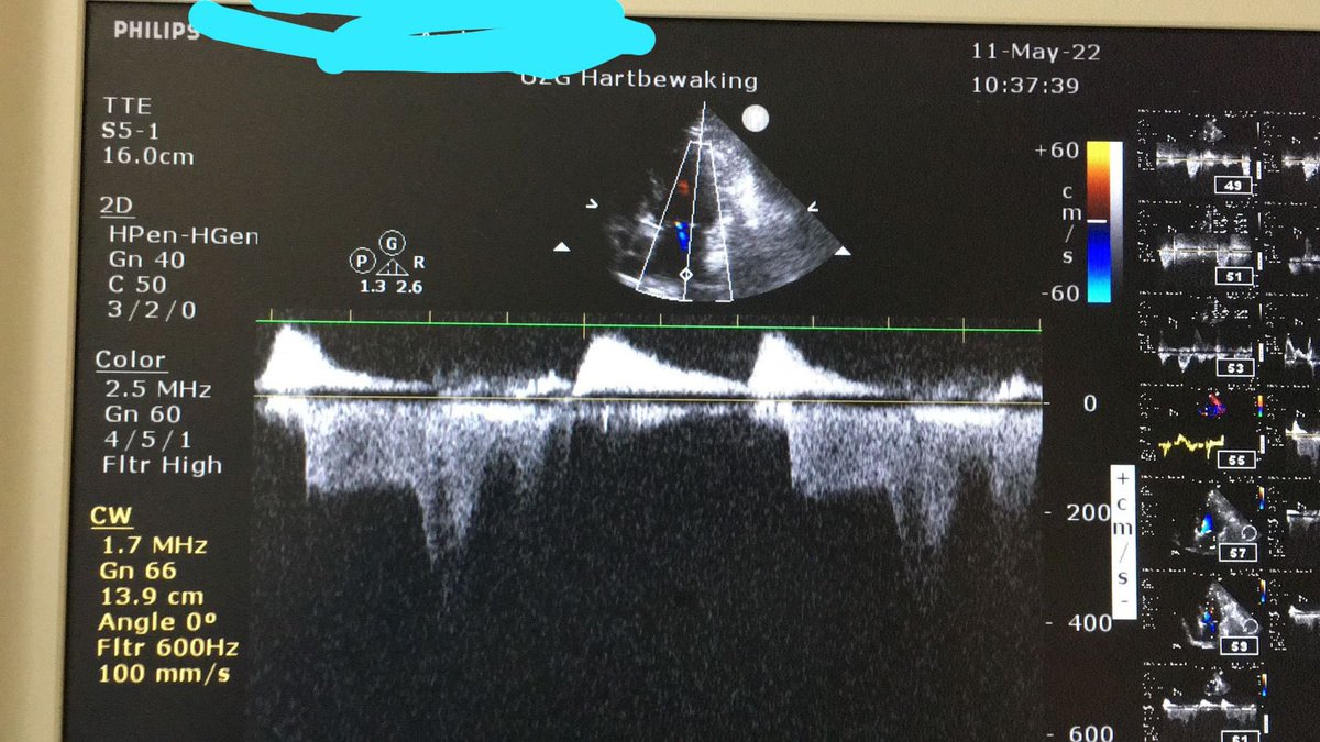 batman_echo's tweet photo. What is CW signal under the A-wave? My echo fellow asked me: “Can you have forward and retrograde flow at the same time?” What would be your answer to this question? https://t.co/IDVoQWZXYw