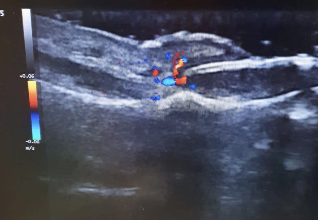 La retroniquia puede producir un dolor muy intenso por la inflamación del pliegue proximal ungueal y la sobreinfección. Aquí el hallux valgus (juanete) del paciente es el factor desencadenante.

La solución es sencilla:laminectomía total con alivio rápido del dolor

La eco ayuda!