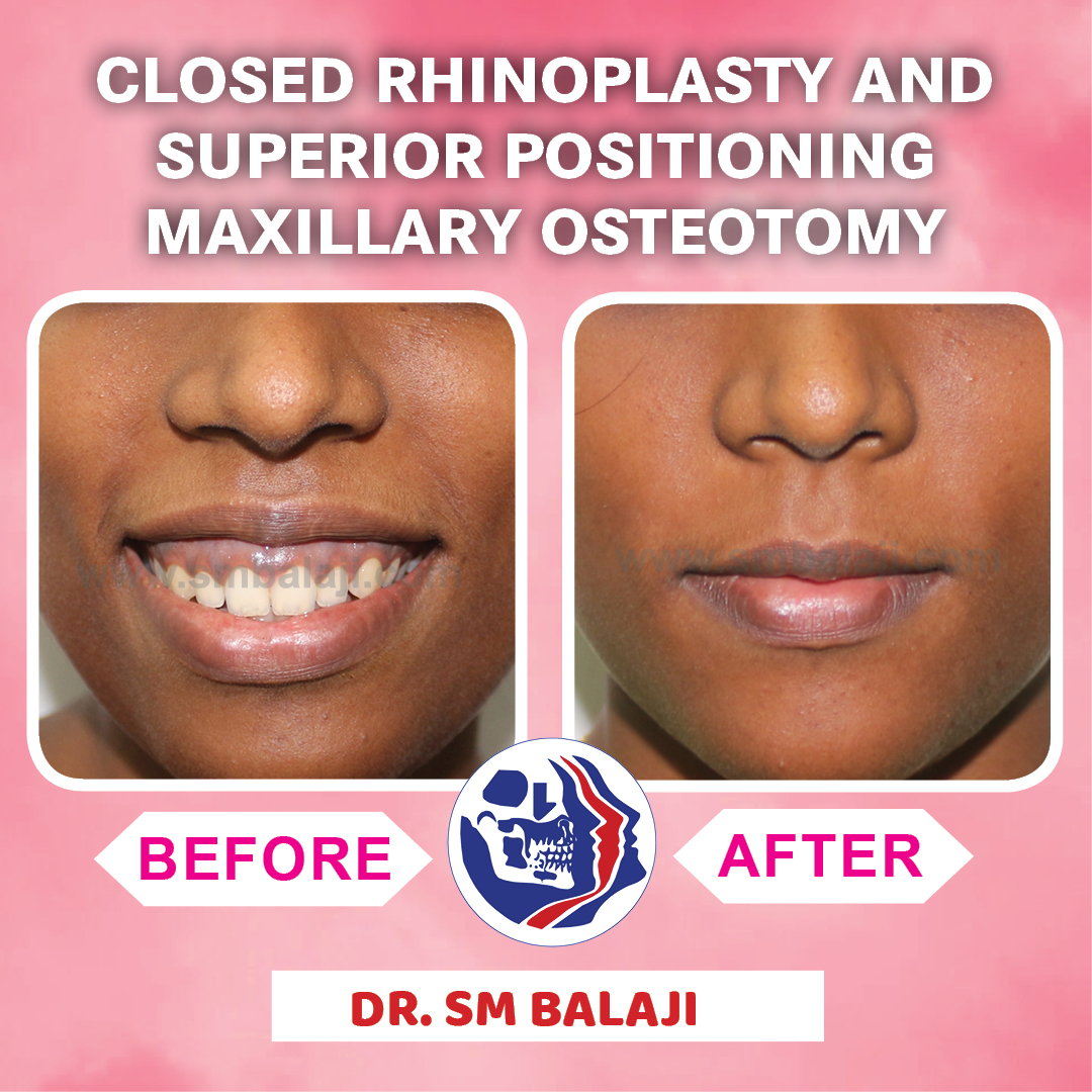 balajidental's tweet photo. Closed Rhinoplasty and Superior Positioning Maxillary Osteotomy
#ClosedRhinoplasty #MaxillaryOsteotomy #Osteotomy #drsmbalaji #smbalaji #balajidental #maxillofacialsurgeon #maxillofacialsurgery https://t.co/hLGLbw8hFF