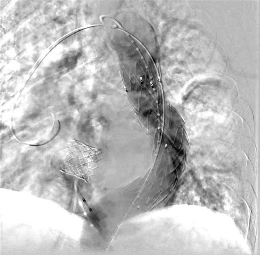 Beaumont Interventional Cardiology Fellowship (@beaumontic) on Twitter photo Severe AS and 6.6 cm saccular thoracic aortic aneurysm treated with simultaneous #TAVR #TEVAR - great team collaboration ->> great patient care 👏 <a href="/amrabbasmd/">Amr Abbas</a> <a href="/IvanHansonMD/">Ivan Hanson</a> <a href="/BrianRenard1/">Brian Renard</a> <a href="/BeaumontCards/">William Beaumont Hospital - Cardiology Fellowship</a> #cardiotwitter #structuralheart Severe AS and 6.6 cm saccular thoracic aortic aneurysm treated with simultaneous #TAVR #TEVAR - great team collaboration ->> great patient care 👏 <a href="/amrabbasmd/">Amr Abbas</a> <a href="/IvanHansonMD/">Ivan Hanson</a> <a href="/BrianRenard1/">Brian Renard</a> <a href="/BeaumontCards/">William Beaumont Hospital - Cardiology Fellowship</a> #cardiotwitter #structuralheart