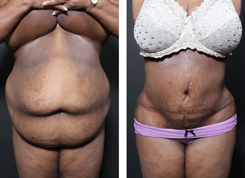 DrRepta's tweet photo. Plus-size or high BMI patients can have safe and effective body contouring surgery which can make a powerful positive impact in their life.  We created the plus size tummy tuck ® procedure specifically for this. #plussizetummytuck https://t.co/gljth9egRh