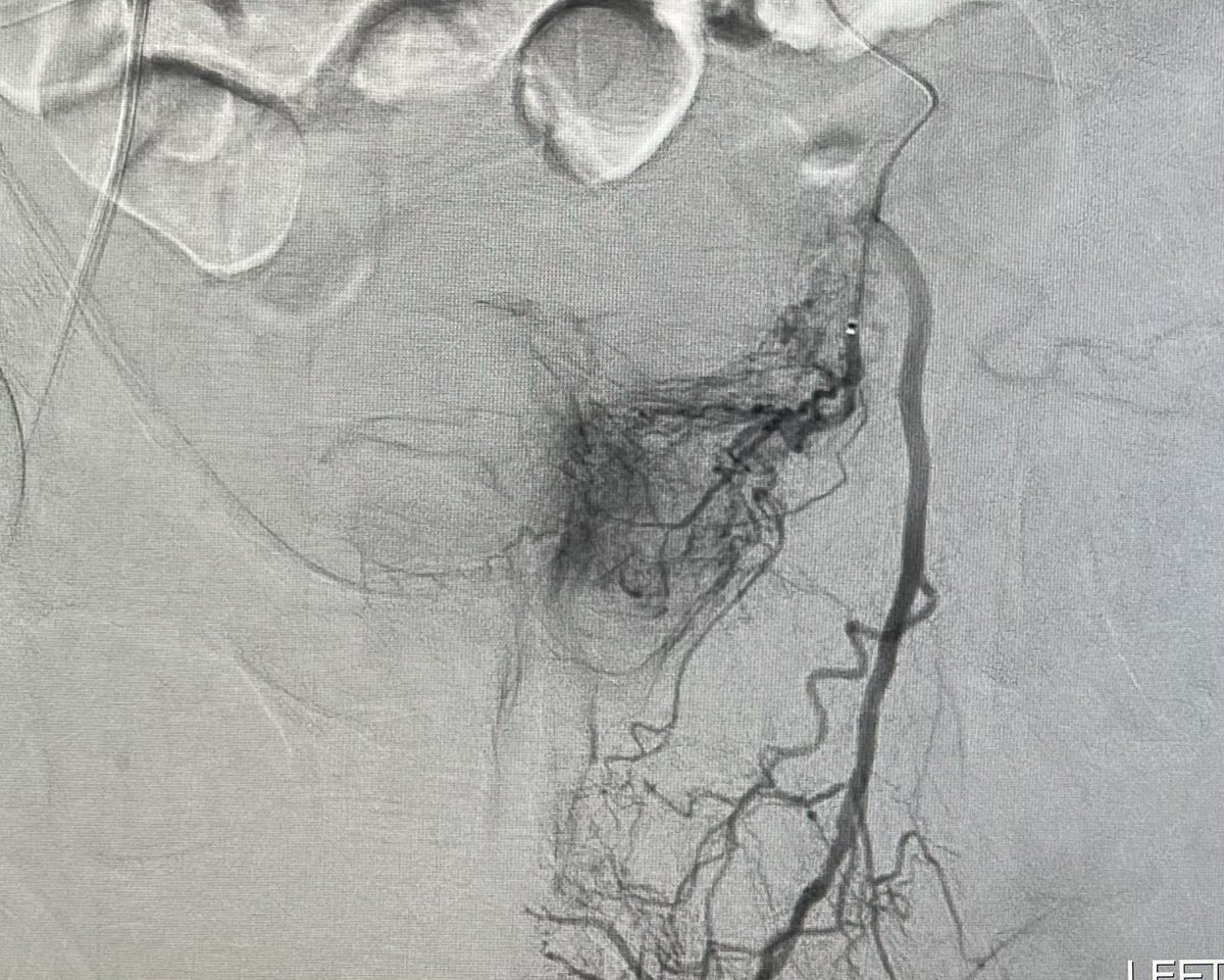 In our times of limited contrast, how little can you use to do a successful PAE? I used 40 mL and 63 mins of sedation on this one. What about you? <a href="/AriIsaacsonMD/">Ari Isaacson</a> <a href="/SandeepBaglaMD/">Sandeep Bagla MD</a> <a href="/MCRadiologists/">Medical Center Radiologists</a>