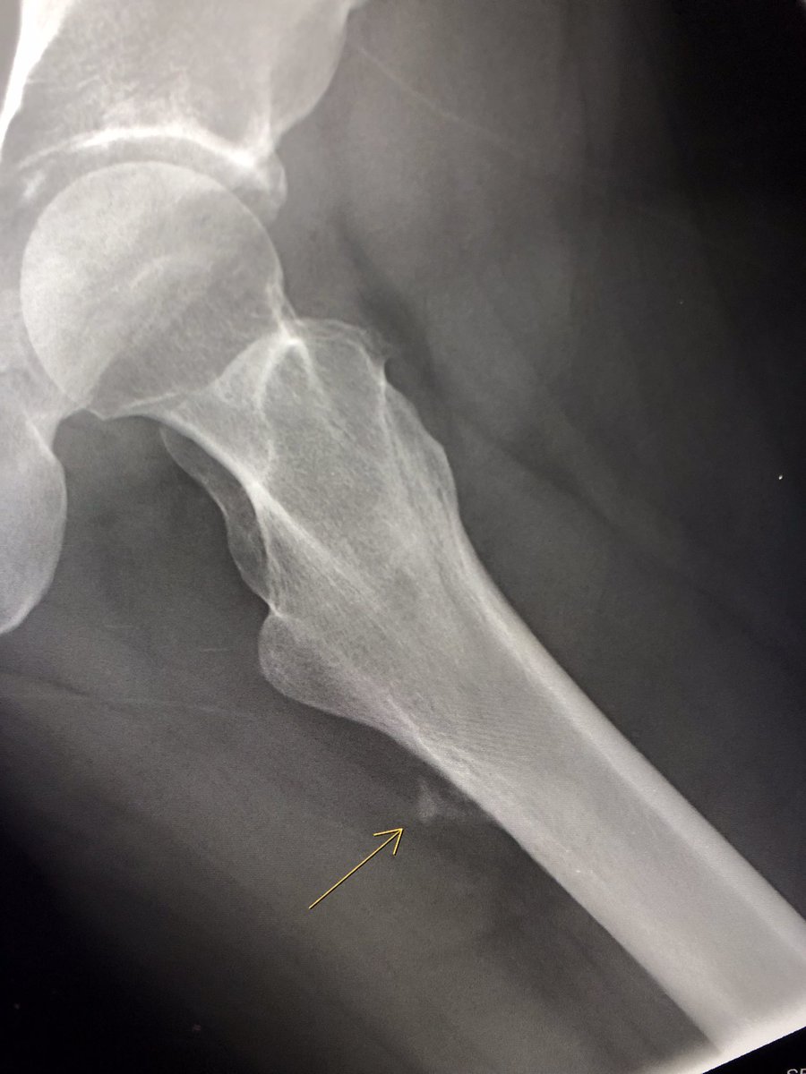 bacole26's tweet photo. Hydroxyapatite deposition disease (HADD) at glut max insertion (linea aspera) with reactive changes https://t.co/FiNN52hctC