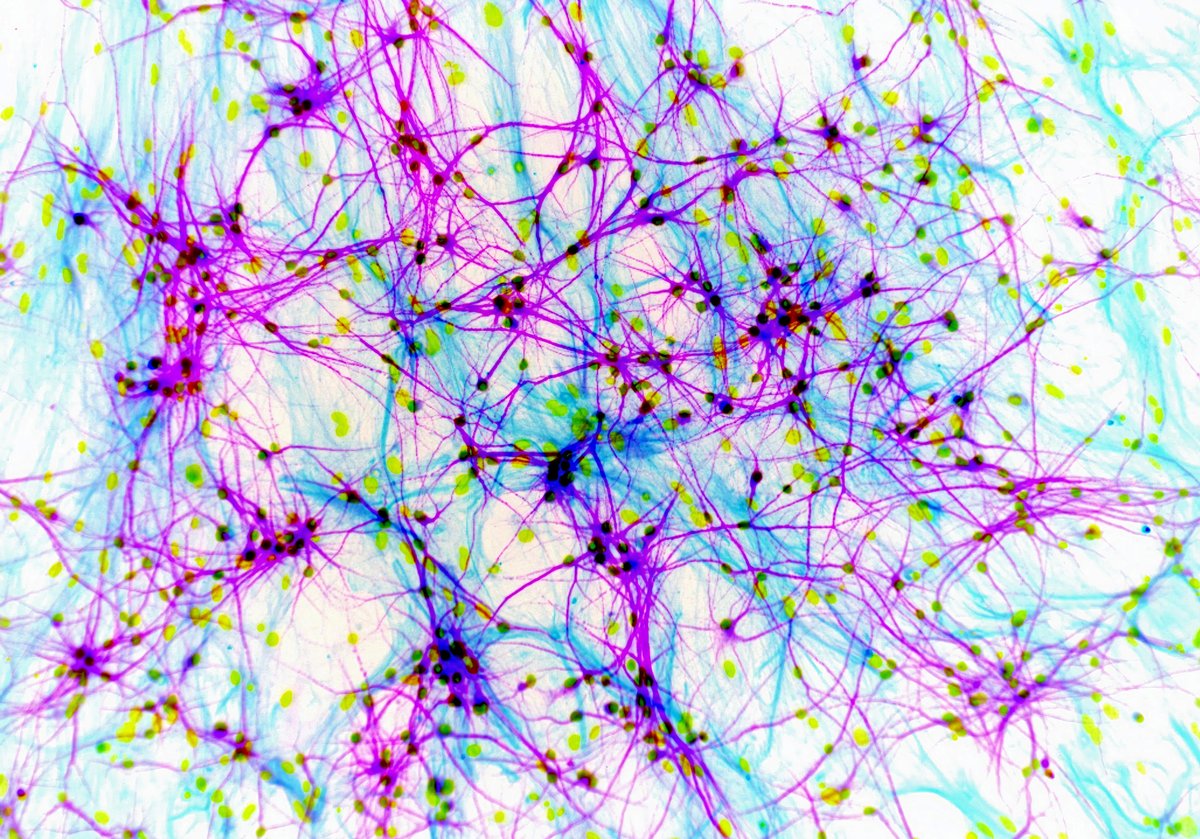SinaiBrain's tweet photo. In @SeaverAutism's @mitzykibum's Abstract Expressionist "Pollock Neurons", #Immunofluorescence of human glutamatergic #Neurons derived from #StemCells DRIP &amp; SPLASH PURPLE. VOTE NOW for #ArtoftheBrain #16 / MOST 💟s WINS! https://t.co/oDwllbfjWn
