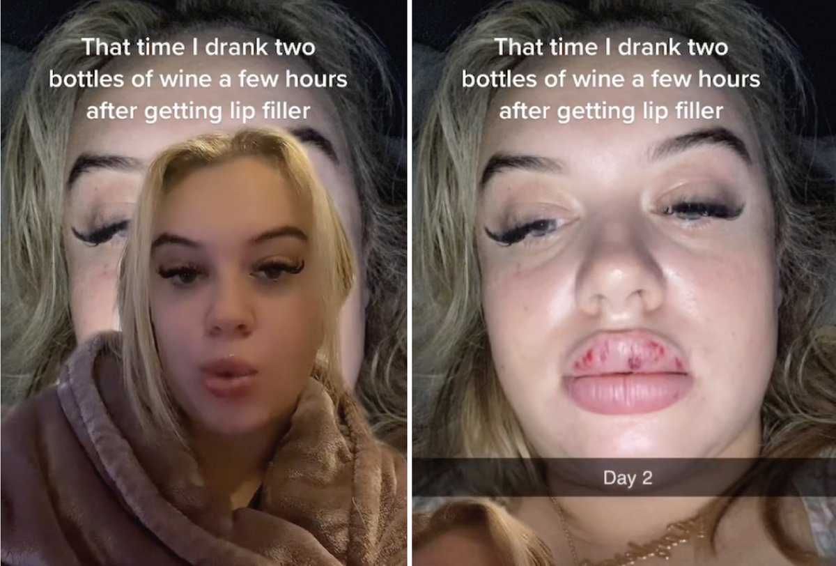 MetroJornal's tweet image. 👄 Ela não seguiu a recomendação e ficou desesperada com o &quot;resultado&quot; do preenchimento labial.

#preenchimentolabial #tiktok

metroworldnews.com.br/social/2022/05…