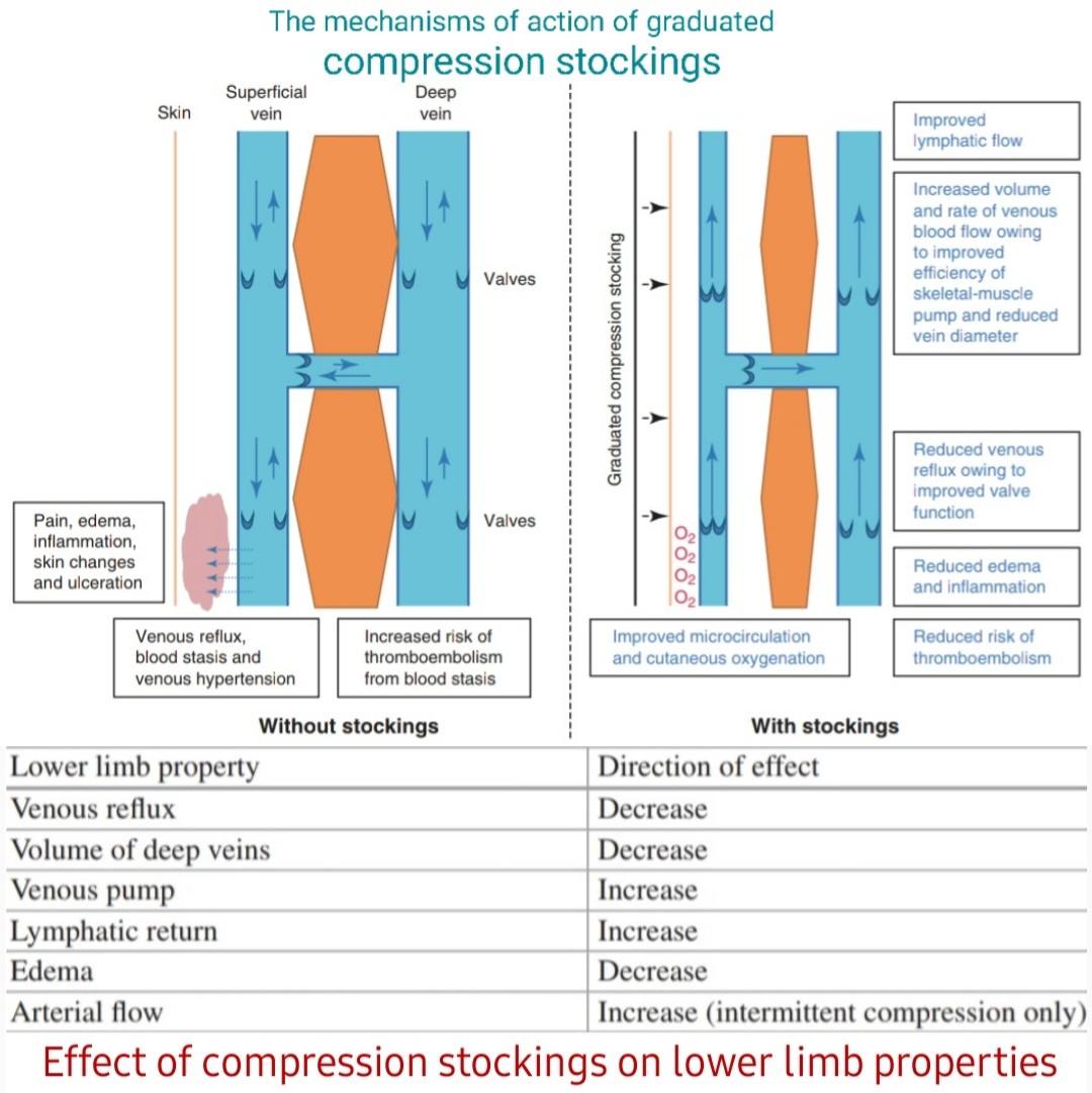 🅐︎ The mechanisms of action of graduated compression stockings 🅑︎ Effect of compression stockings on lower limb properties
𝗥𝗲𝗳: Approach to Lower Limb Oedema, Springer, 2022
#Varicosevein #vascularsurgery
#MedTwitter