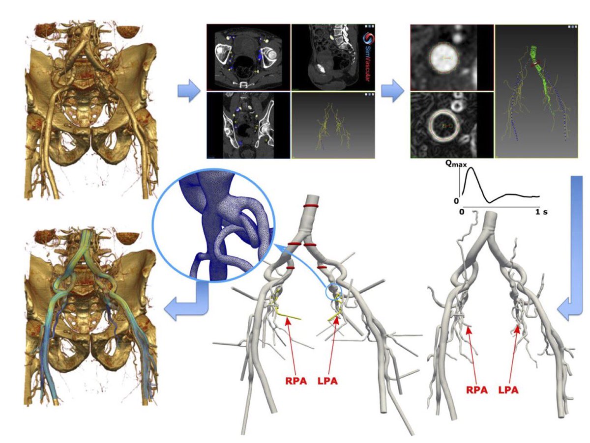 Mostafa_CFD's tweet photo. Today, we have published our work on the first computational fluid dynamics (CFD) model of #PAE. We show how CFD and particle tracking could be used to optimize the effectiveness of this treatment strategy. https://t.co/1mVDeHke8l https://t.co/FqRyt91RMM