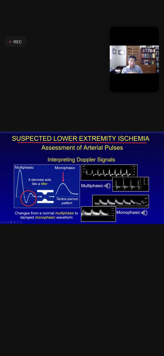 KalagaraHari's tweet photo. #POCUS 
Excellent webinar of #POCUS for vascular applications 👇@POCUSAcademy 
🔺DVT
🔺Lower extremity ischemia
🔺AAA
🔺Vascular access
🔺 Screening for complications
Absolutely great webinar!! Thx @ASRA_Society @ACEPNow @ASALifeline @RJonesSonoEM @dan___kim @NephroP @RubbleEM https://t.co/SNIjvfOdB0