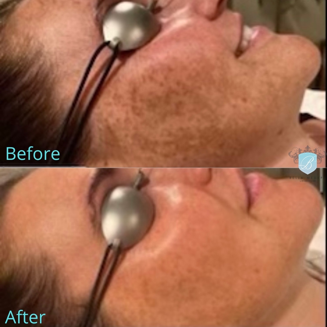 bellamedspa3's tweet photo. Tighten, lighten, smooth & GLOW…then GO! w/ The Total Skin Solution! Genius RF & Lase MD. #thetotalskinsolution #genius #geniusrf #lasemd #bellamebeautiful https://t.co/O9zYynbe8J